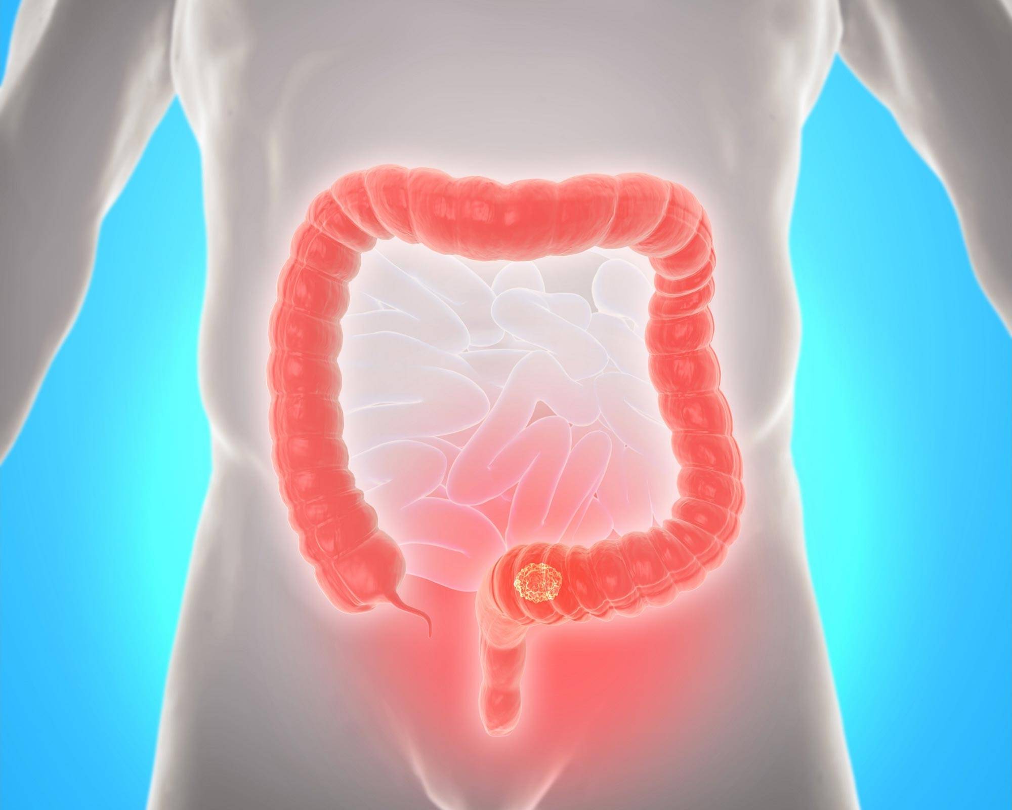 What Is Colorectal (Colon) Cancer?