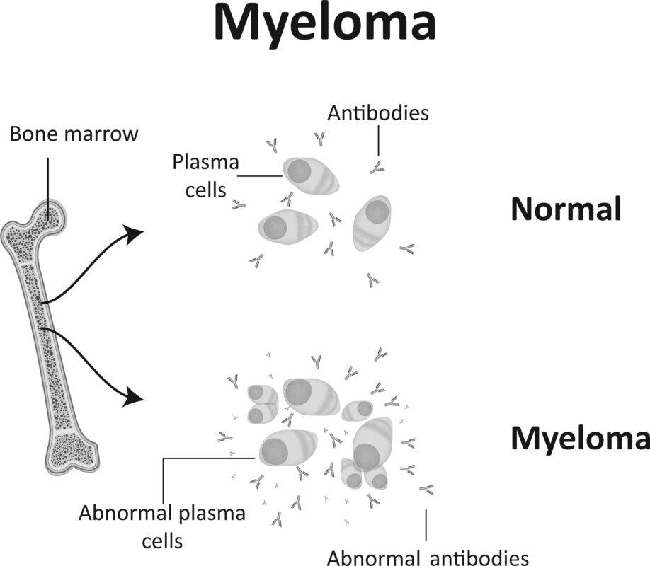 What Is myeloma ?