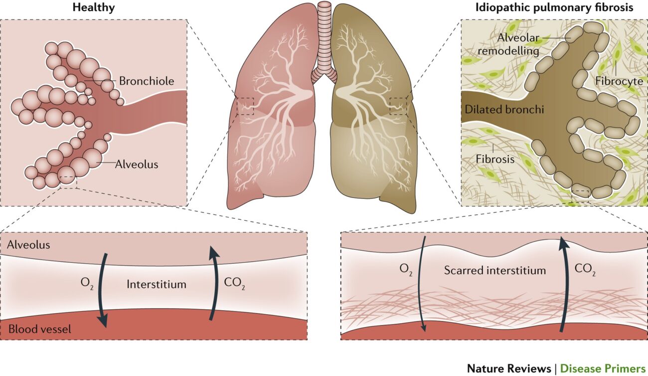 Idiopathic Pulmonary Fibrosis