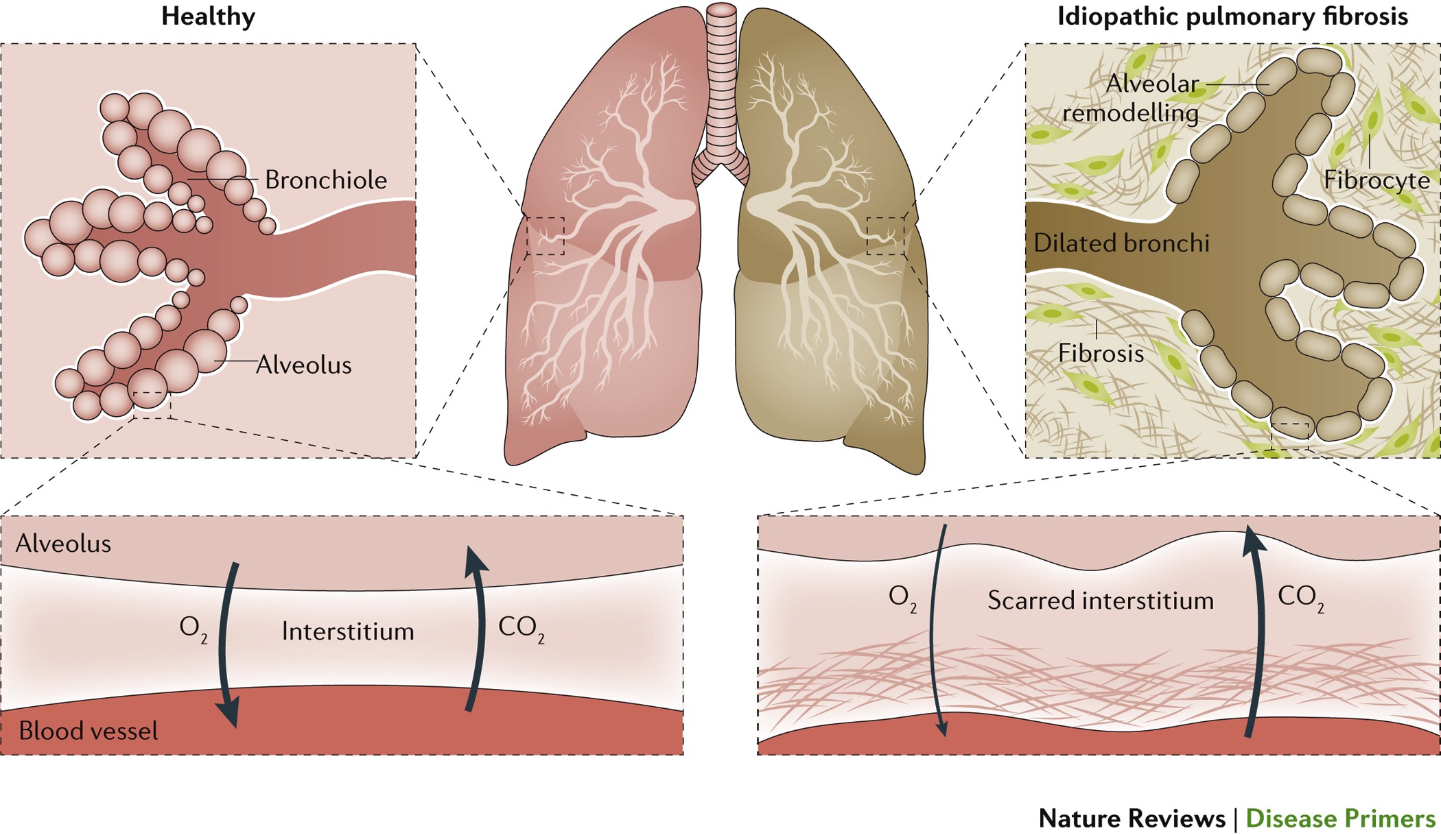 Idiopathic Pulmonary Fibrosis