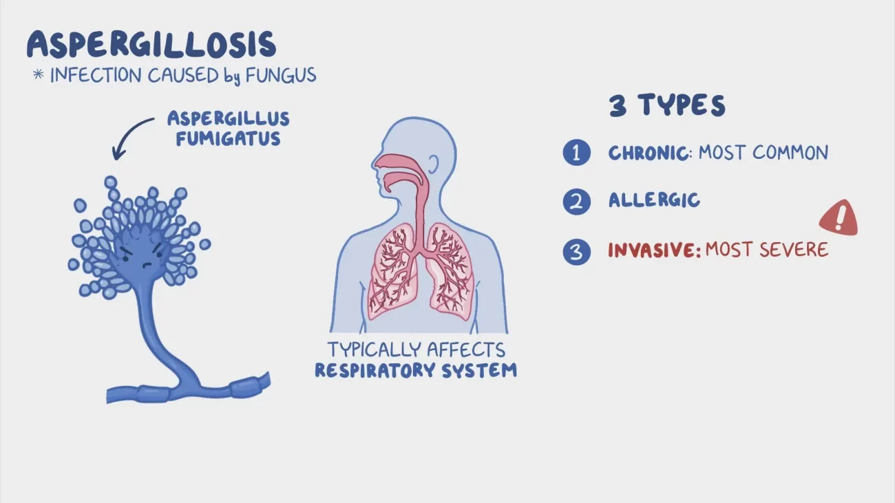 Invasive Aspergillosis