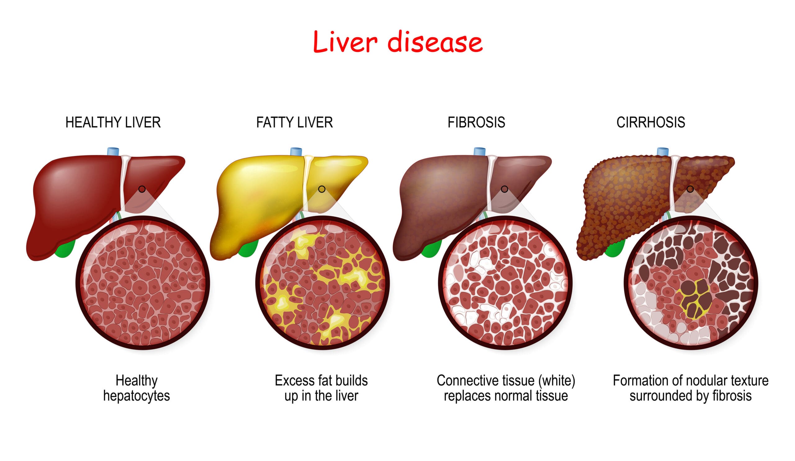 What is Liver Fibrosis?