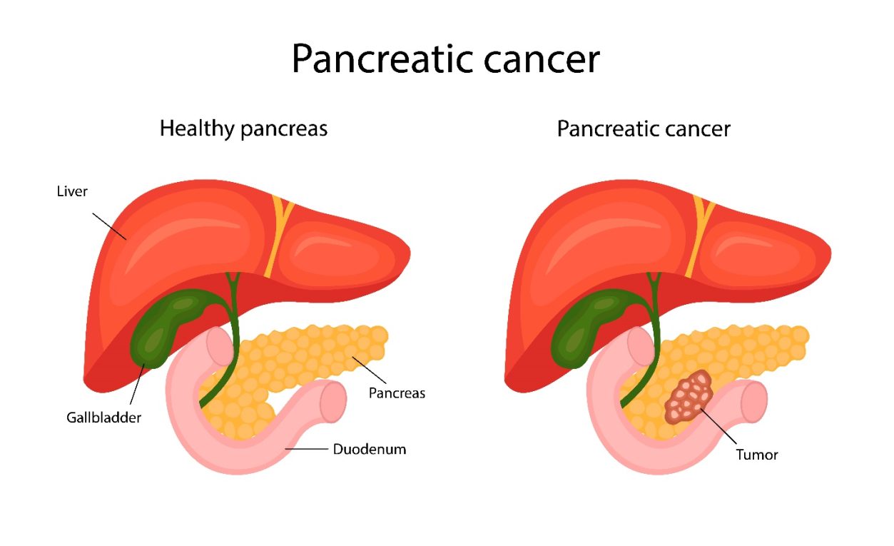 What is Pancreatic Cancer?
