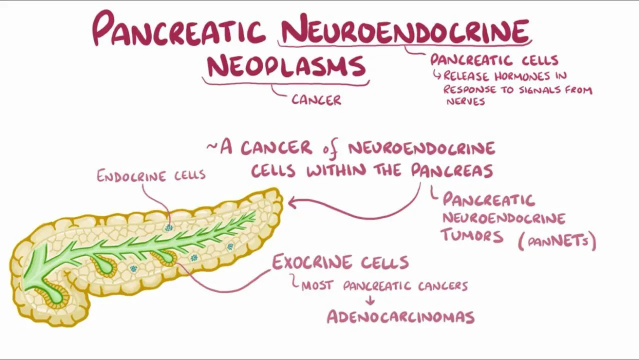 Pancreatic Neuroendocrine Tumors
