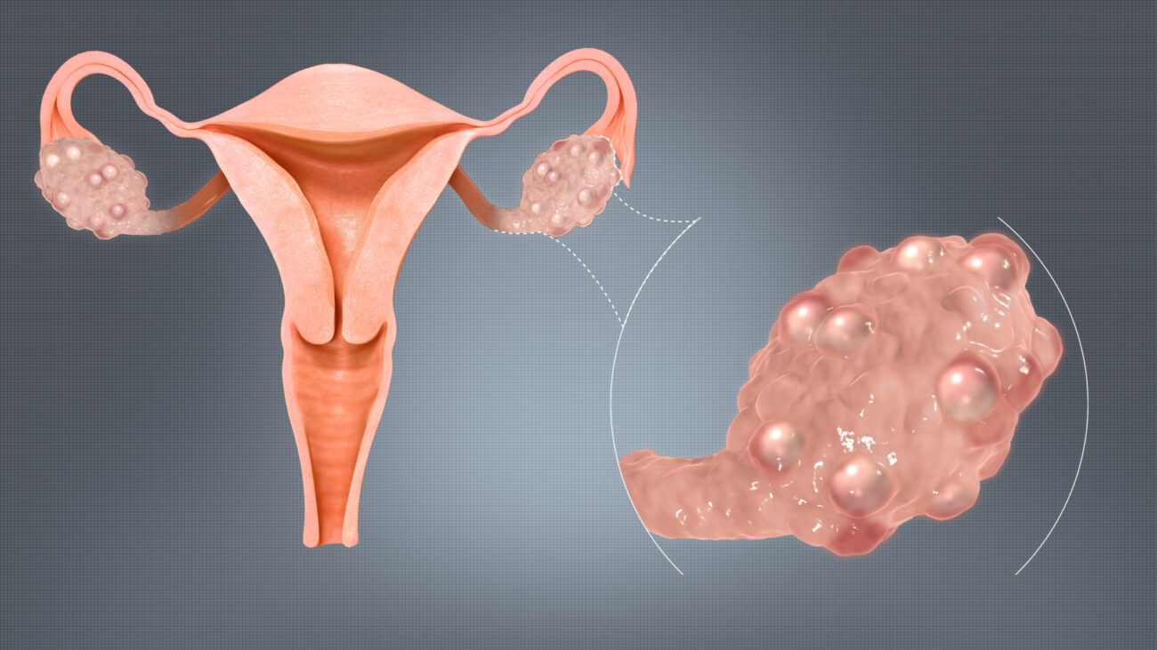 What is Polycystic Ovarian Syndrome?