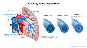 What is Pulmonary Arterial Hypertension?