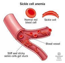 Sickle Cell Anemia