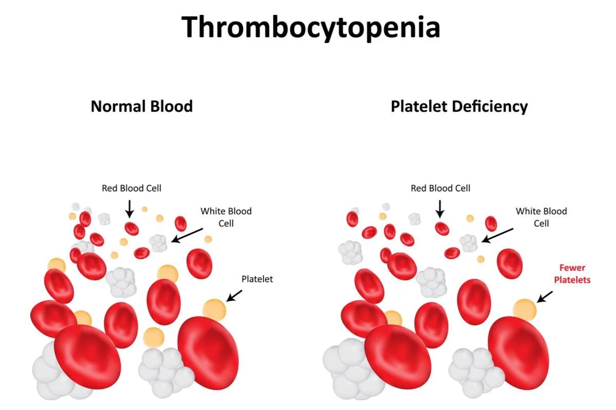 What is Thrombocytopenia?