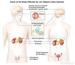 What is Von Hippel-Lindau Disease